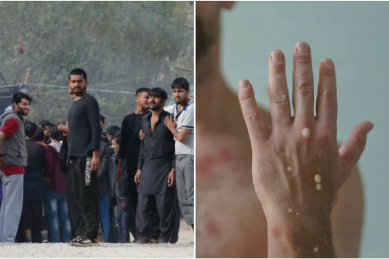 Blažuj: Migrant ima majmunske boginje