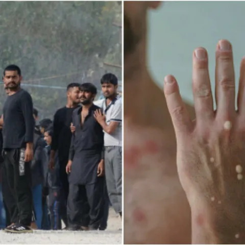 Blažuj: Migrant ima majmunske boginje